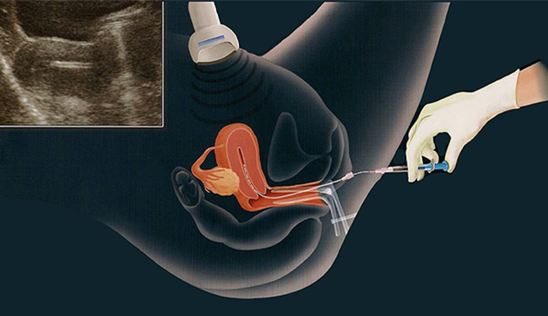 Gravidez com óvulos doados